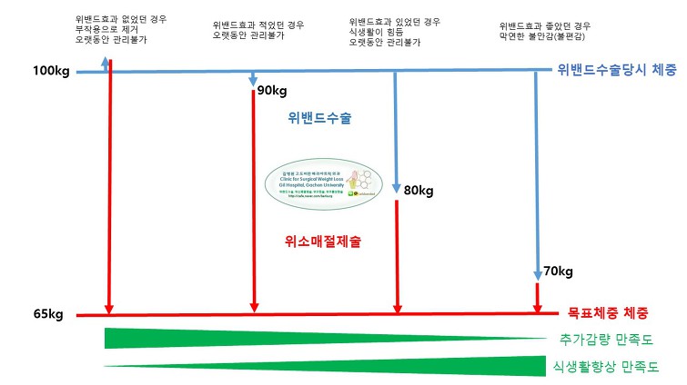 위밴드수술에서 위소매절제술로 전환